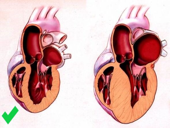 Cardione zabraňuje ventrikulárnej hypertrofii srdca